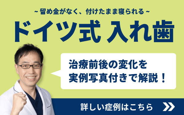 止め金具が無く付けたまま寝られる ドイツ式入れ歯