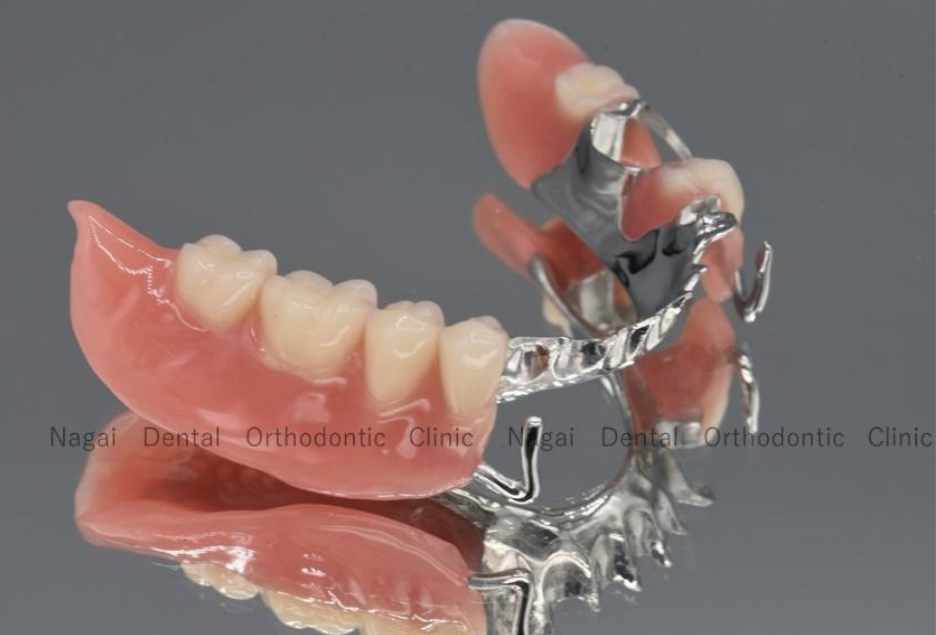 金属部分義歯