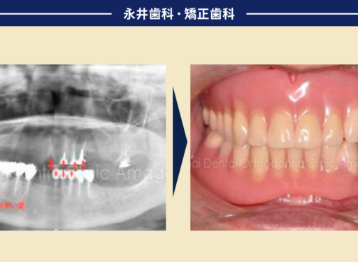 部分入れ歯が合わず、歯ぐきが腫れてきた…