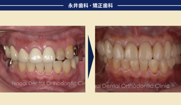 つねに噛める状態を保ちながら<br>３年の徹底治療でここまで美しく