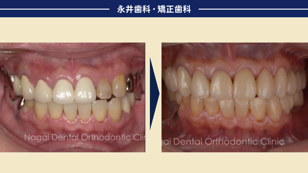 つねに噛める状態を保ちながら<br>３年の徹底治療でここまで美しく