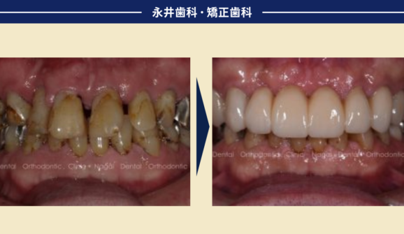 硬くて丈夫なセラミックが割れた!?<br>「ボンドでつけて」と言われたが…