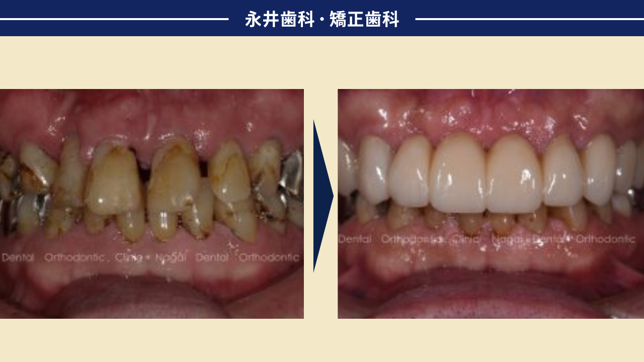 硬くて丈夫なセラミックが割れた!?<br>「ボンドでつけて」と言われたが…