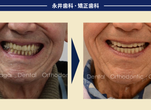 傾いた入れ歯。修理ばかりの繰り返し…。86歳、食べる楽しみを取り戻すために