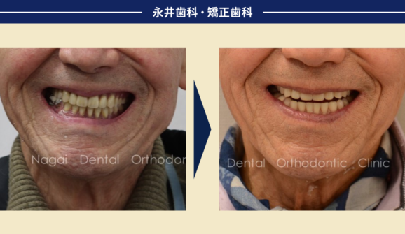 傾いた入れ歯。修理ばかりの繰り返し…。86歳、食べる楽しみを取り戻すために