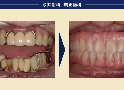 入れ歯はイヤ！の思いのままに…