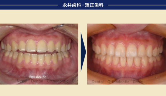 20代女性。開咬　前歯で噛めない