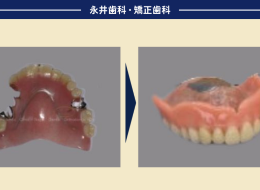 70代男性。ピーナッツが食べられる入れ歯に出会えた！ドイツ式入れ歯