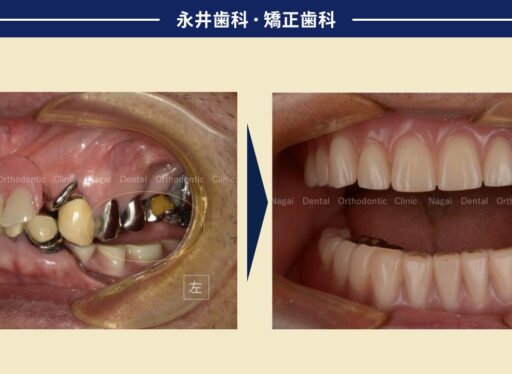 90代男性。歯が残っていても、噛めない。おいしいものが食べたい