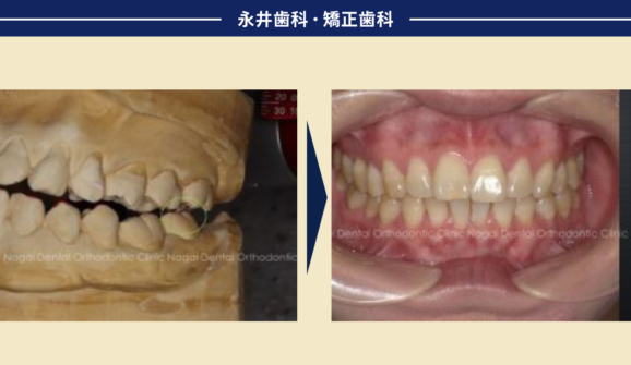 顎関節症でマウスピースが手放せず<br>ひどい肩こりに悩んでいた患者さん