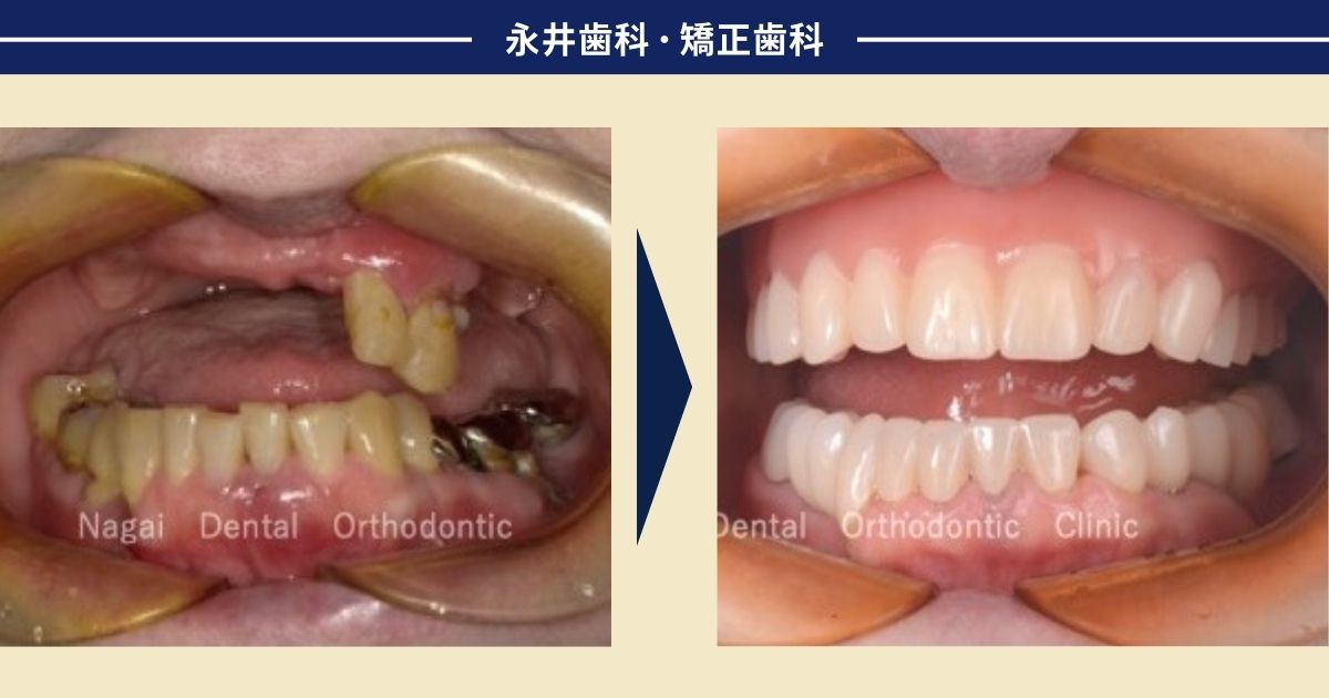重度の歯周病が原因で、残った２本の歯もグラグラして噛めない方の治療方法