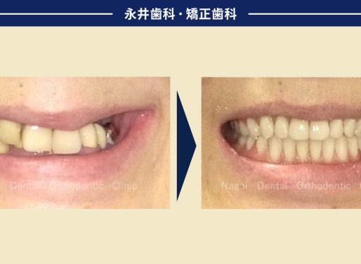 歯医者さんが怖くて通えなかった患者さんが、ドイツ式入れ歯で無事に治療終了