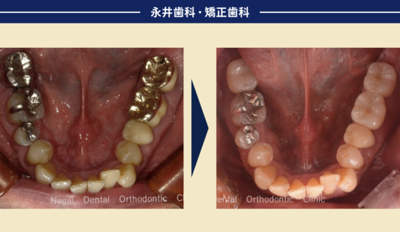 60代男性。奥歯でしっかり噛めるようになって、また食事が楽しめるようになったインプラント治療
