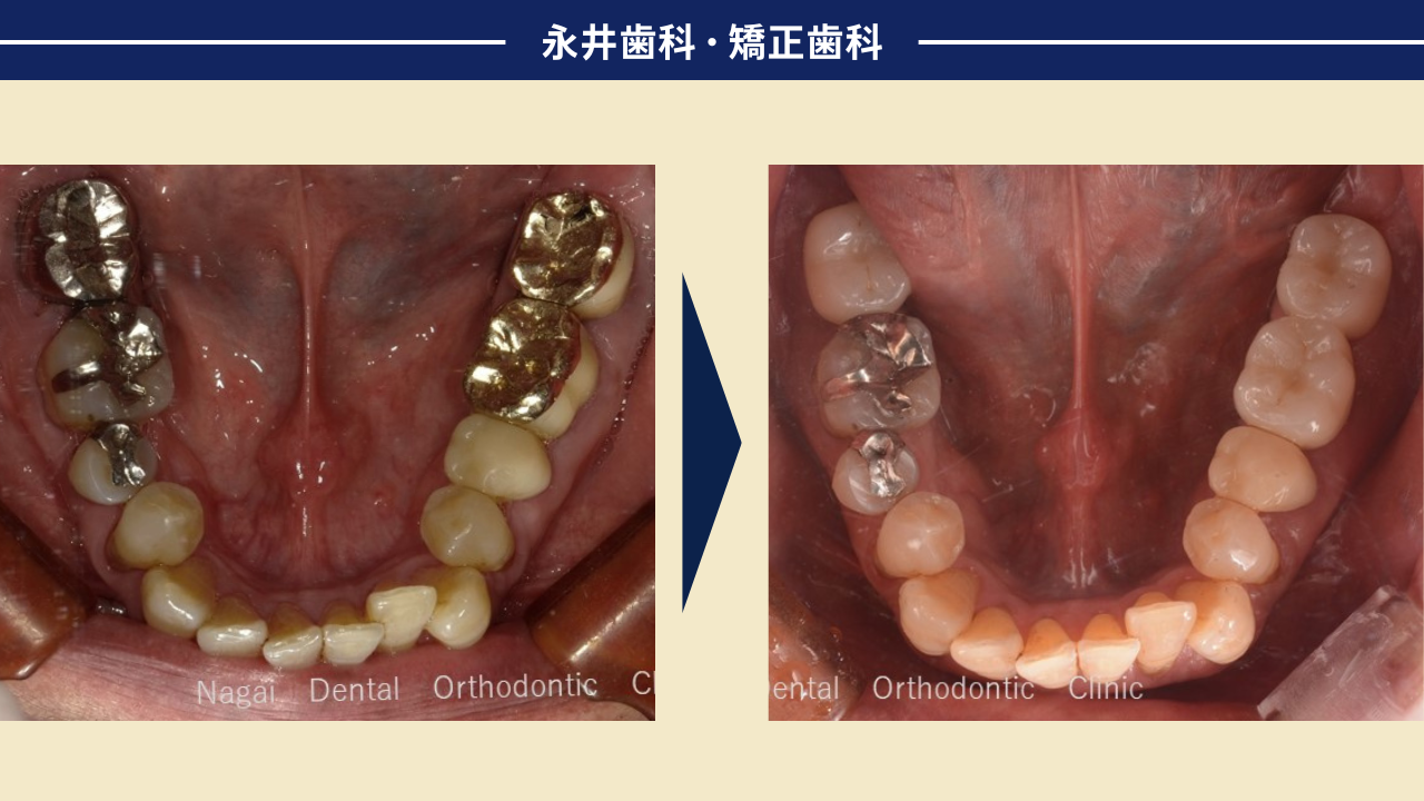 60代男性。奥歯でしっかり噛めるようになって、また食事が楽しめるようになったインプラント治療