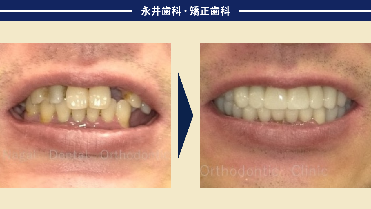 50代男性。日常生活が激変した歯科治療