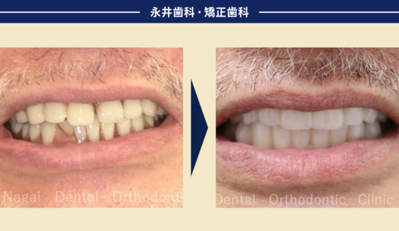 60代男性。部分入れ歯の作り直しや自身の歯のトラブルから卒業できたオールオンフォー